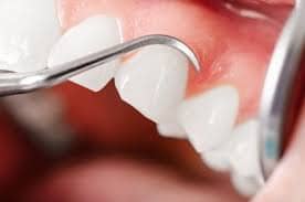 teeth whitening